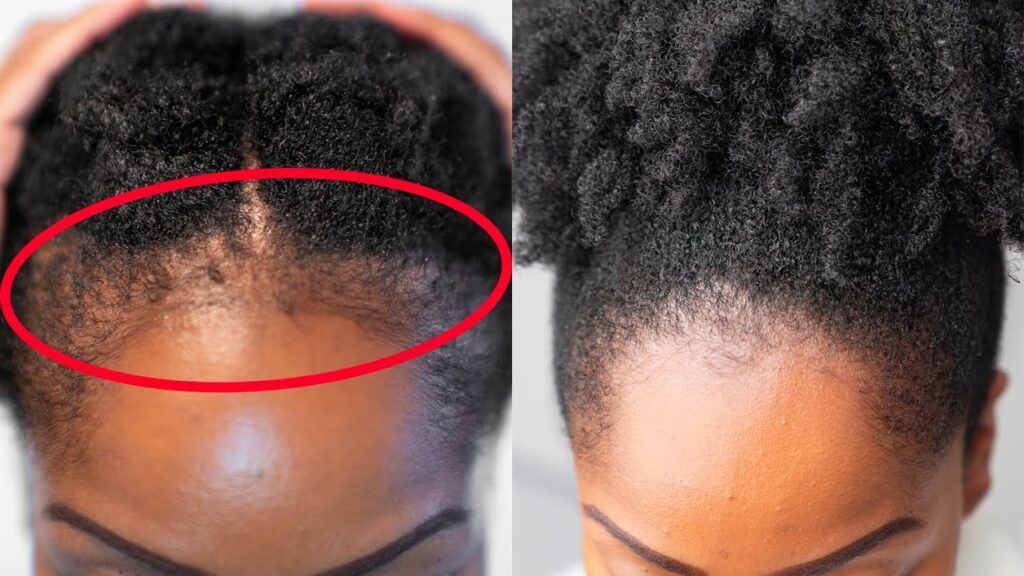 How to grow your hairline Afrik