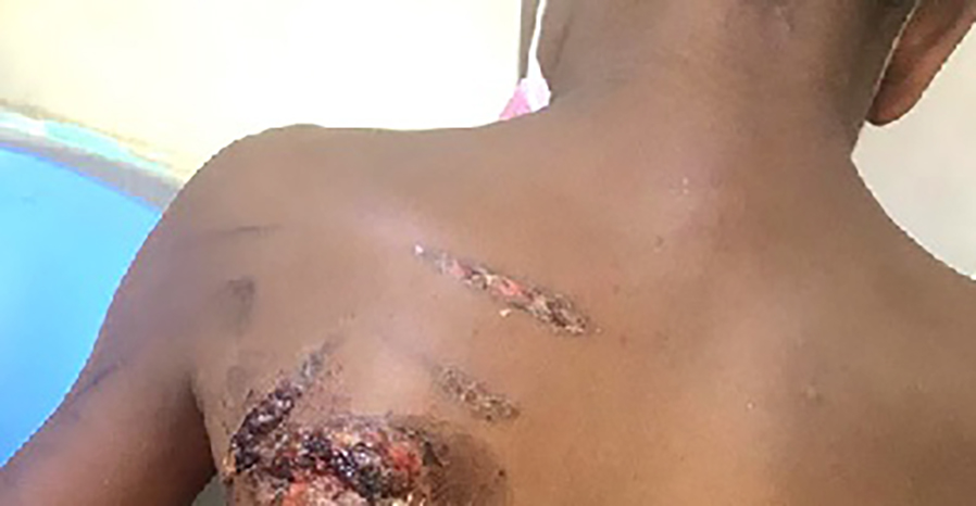 A boy burn with Electric iron